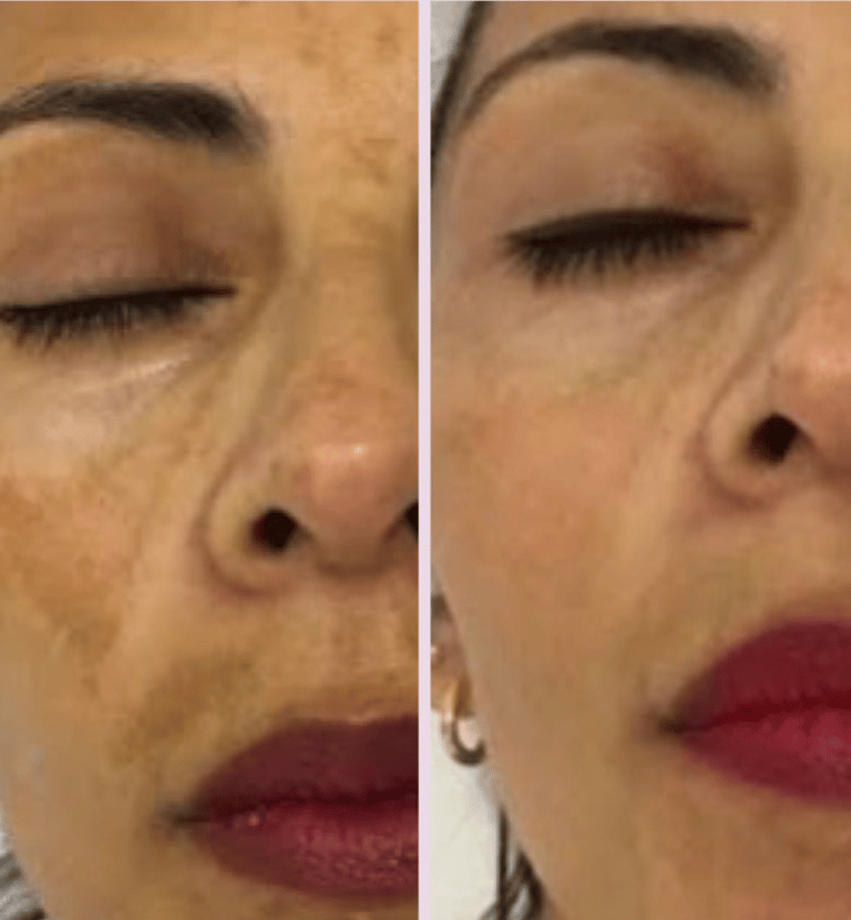 antes y despues de tratamiento facial en señora