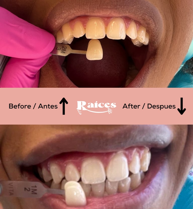blanqueamiento dental tenerife