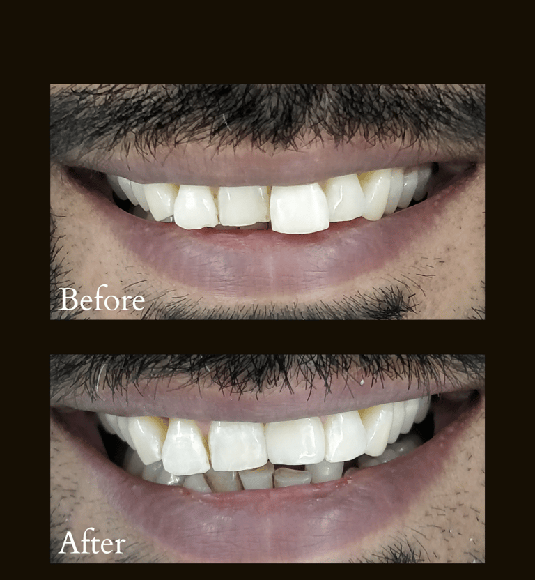 Crooked teeth treatment with ceramic tooth colored cap by Top cosmetic dentist near Orlem Malad west Mumbai