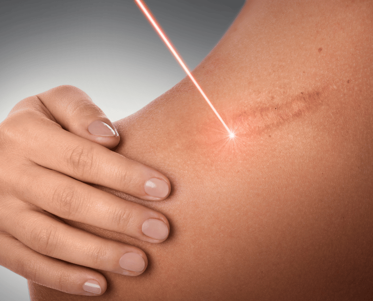 close up of red laser beam on scar for skin treatment