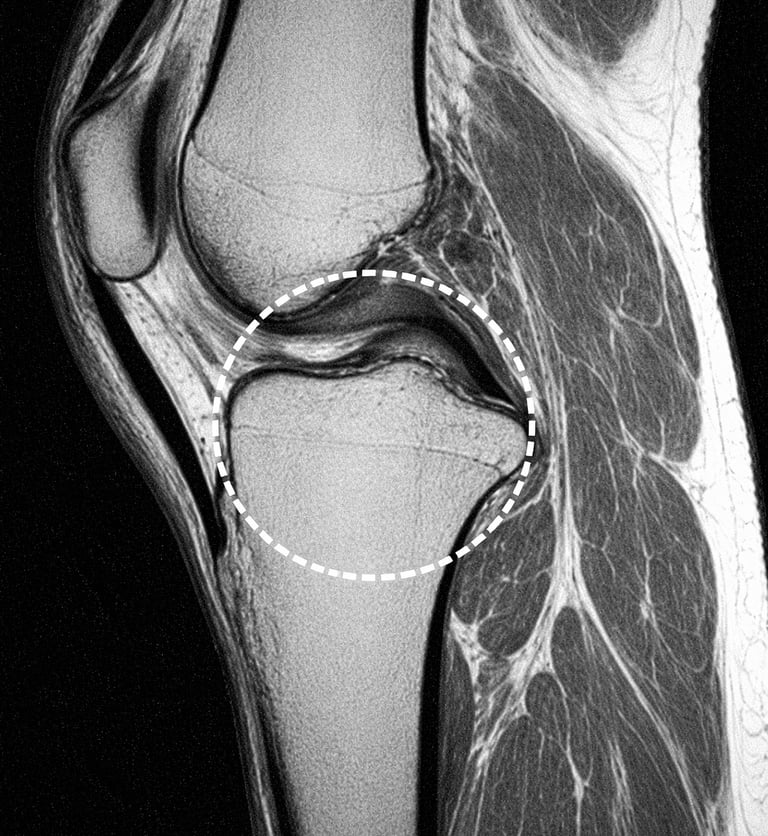 IRM genou menisque lesion
