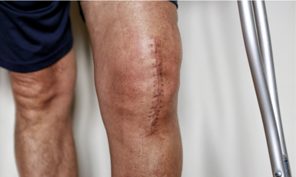 Close-up of a surgical scar on a patient's knee after total knee replacement surgery with crutches.