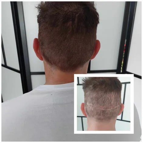 homme qui a une cicatrice sur le cuir chevelu