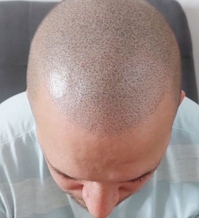 micropigmentation capillaire, effet crâne rasé