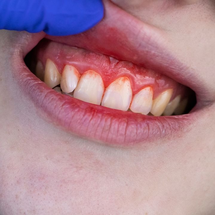 Bleeding gums
