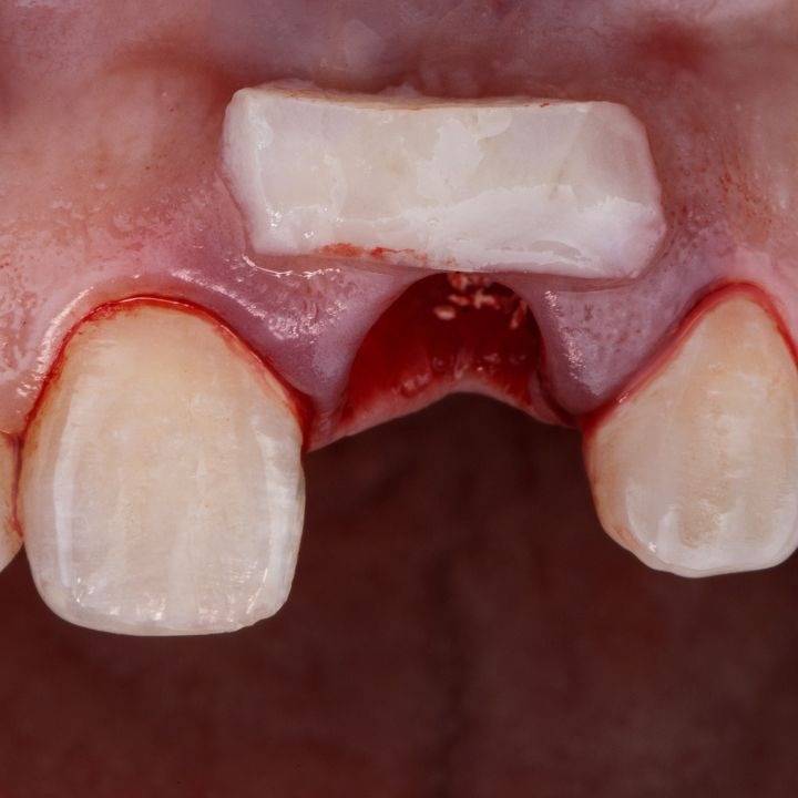 Bone graft