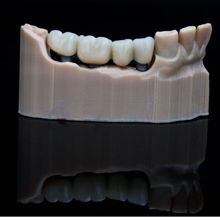 Dental Bridge