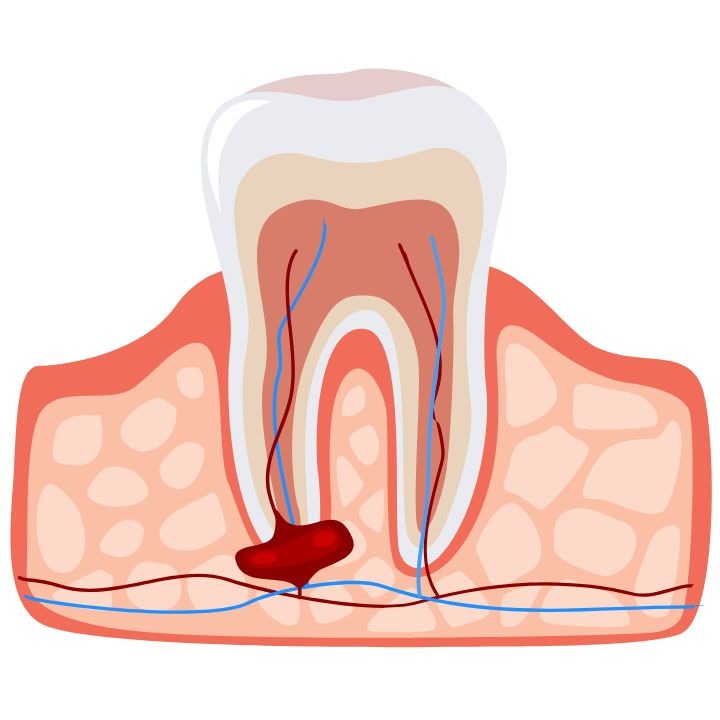 dental cyst