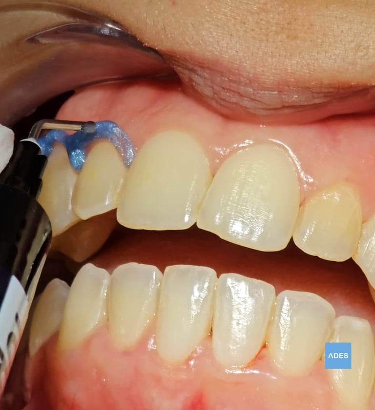blanqueamiento dental