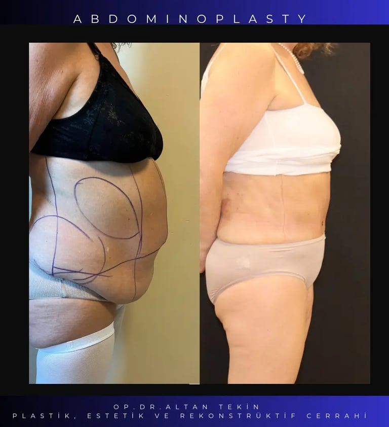 tummuy tuck before after photo, Antalya