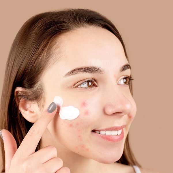 woman putting medicine on her acne