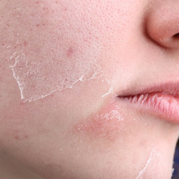 woman with dry skin