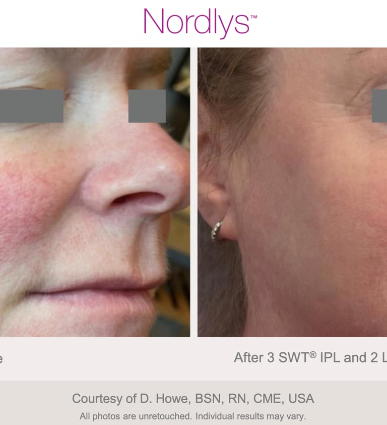 calmed and even skin tone after redness and vascular treatment in Hamilton Ontario
