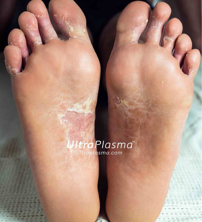 ultra_plasma_ultra_plazma_ultra-plasma_ultra-plazma_foot_fungus_ayak_mantari_tinea_pedis