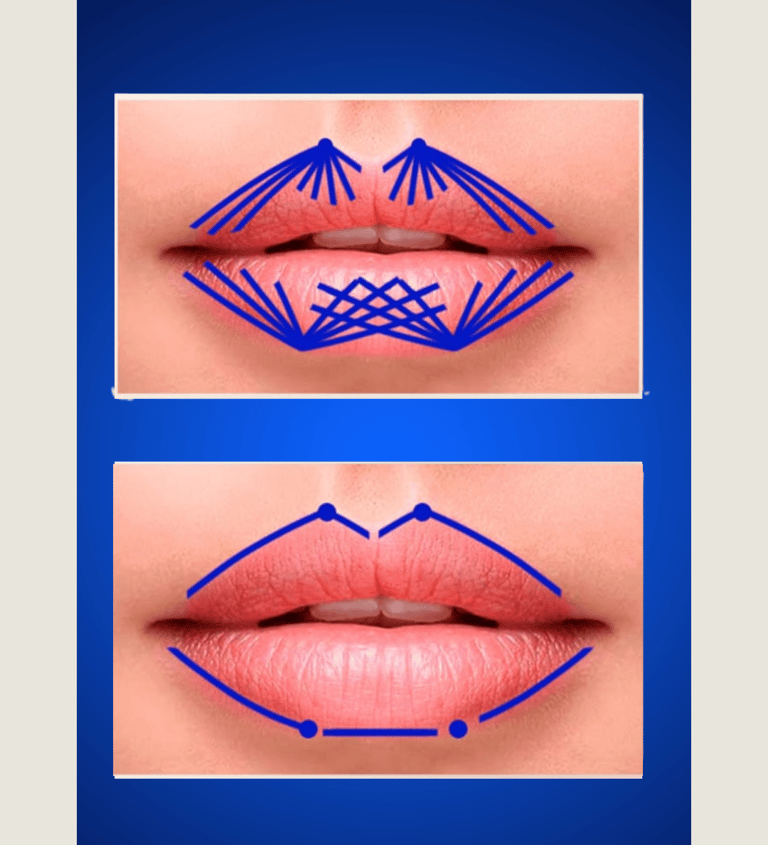 Técnica de preenchimento labial