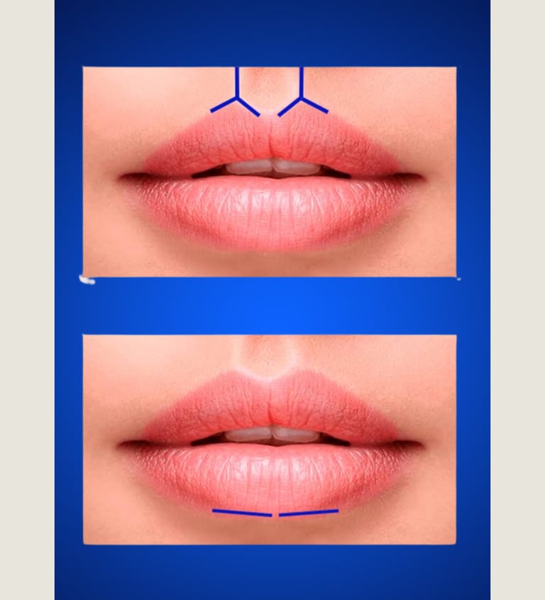 Técnica de preenchimento labial