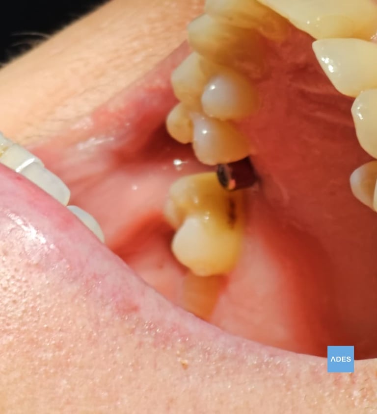 implante dental