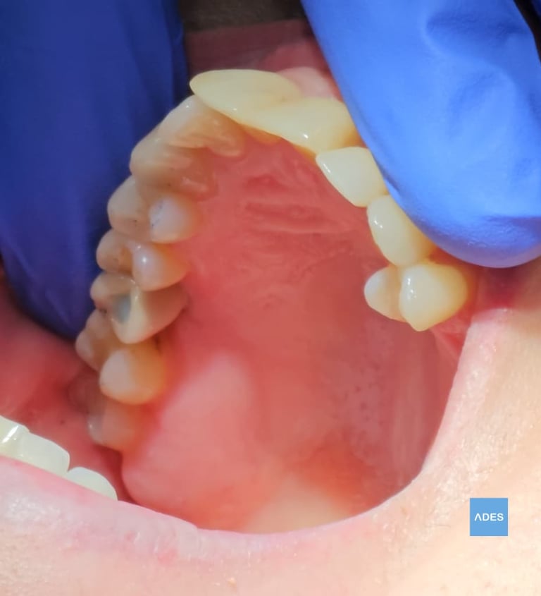 implante dental