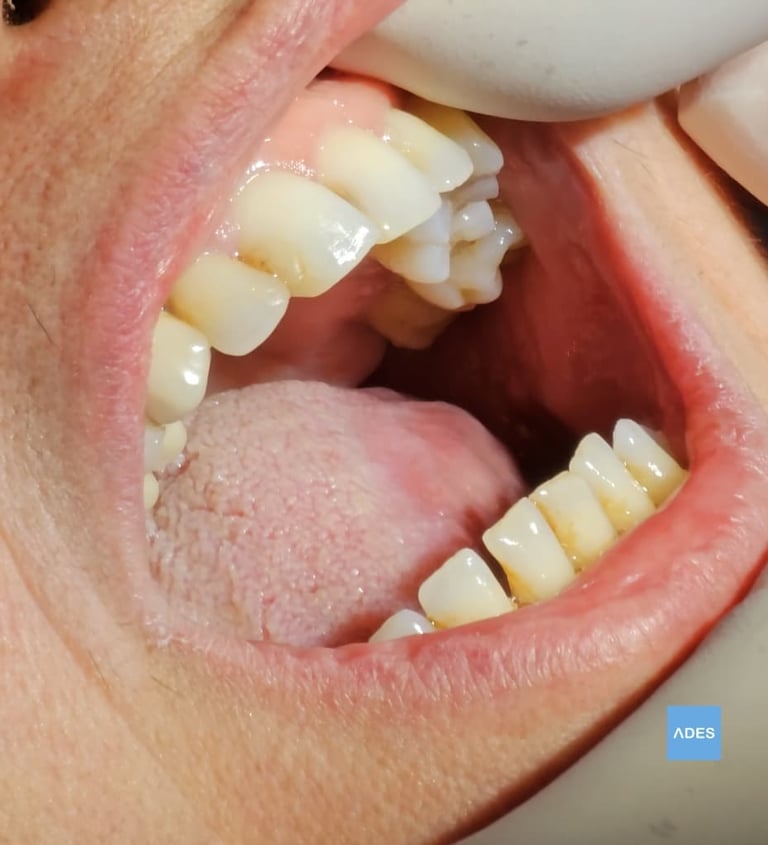 caries
