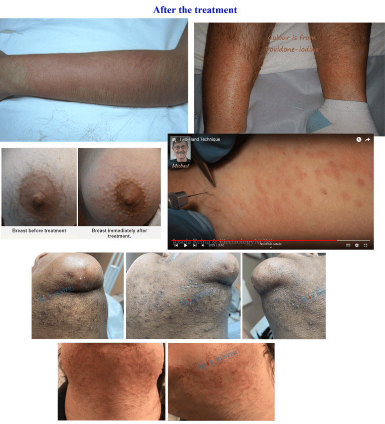after-electrolysis-treatment