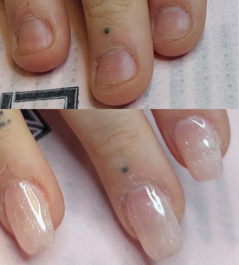 Behandling för nagelbitare
