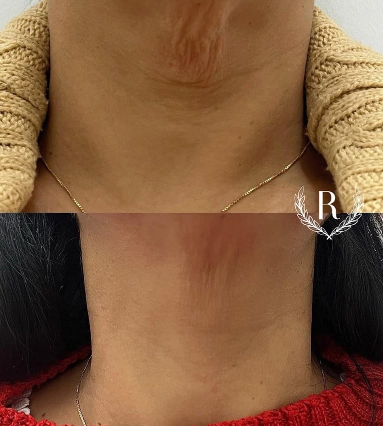bioestimulador de colágeno aplicação facial - clínica estética Tatuapé