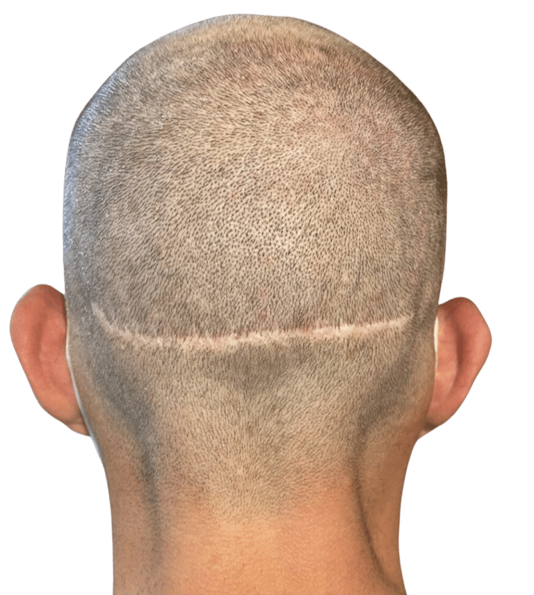 Cicatrice due à une greffe de cheveux pouvant être effacée par la tricopigmentation