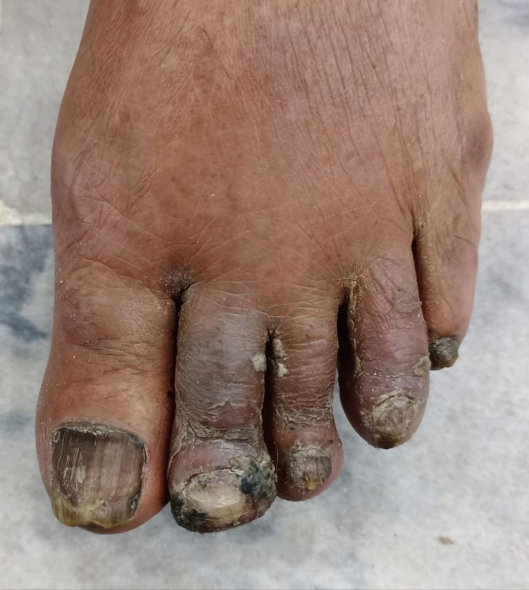 what is perniosis