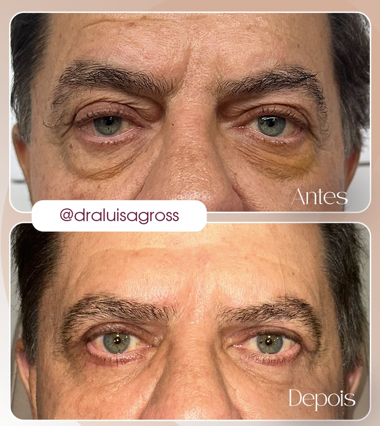 Antes e depois de cirurgia periocular realizada pela Dra. Luisa Gross