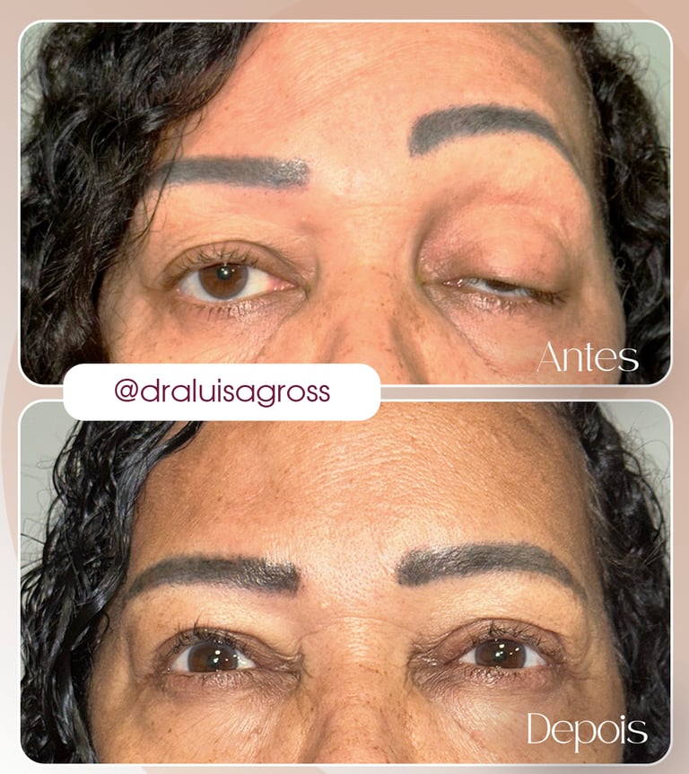 Antes e depois de cirurgia periocular realizada pela Dra. Luisa Gross