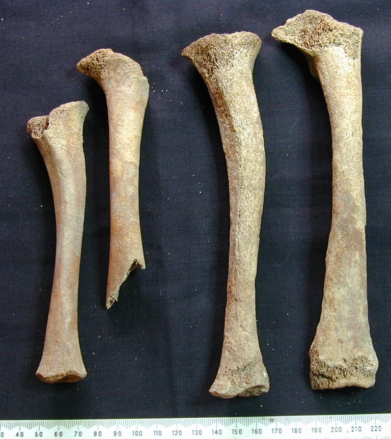 Examples of rickets in the leg bones of two children from Wymondham, Norfolk