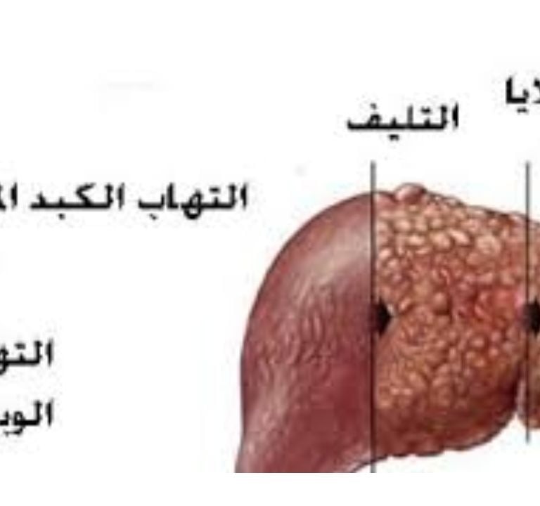 🛡️ اكتشف كيف يمكن أن يدعم الصيام التطوعي والعسل صحة الكبد لدى مرضى فيروس التهاب الكبد الوبائي ج (HC