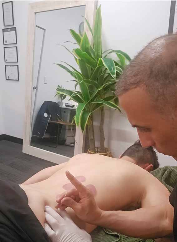 Dry Needling being done by Specialised therapist Moe from Advance Body Massage Wollongong