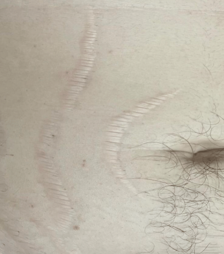healed belly scars