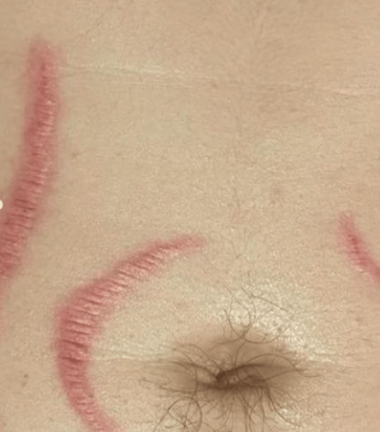 inflamed belly scars