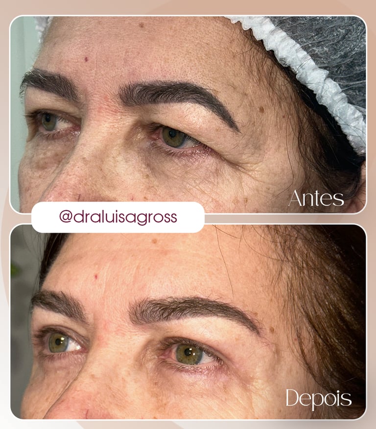 Antes e depois de cirurgia periocular realizada pela Dra. Luisa Gross