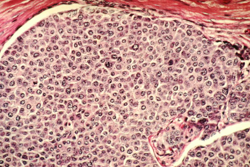 Breast Cancer cells