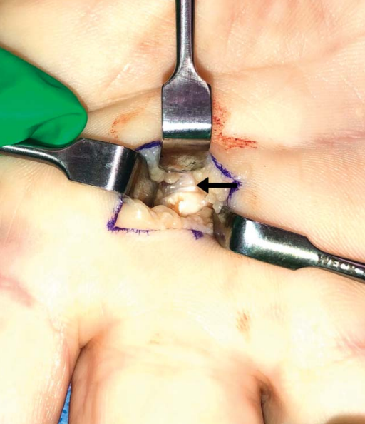 Incisión de 1cm realizada para tratar el dedo en gatillo, la flecha muestra la polea A!