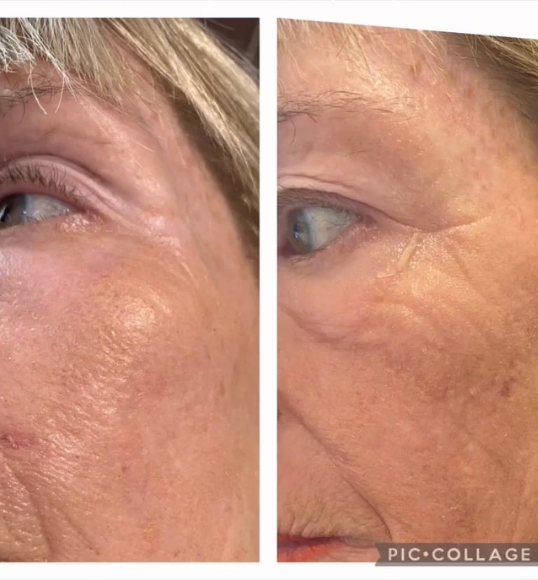 Before and after chemical skin peeling, skin boosters and fillers