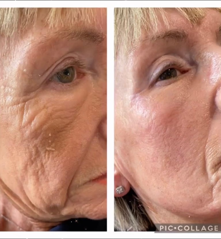 Chemical skin peels, skin booster and filler treatemnt