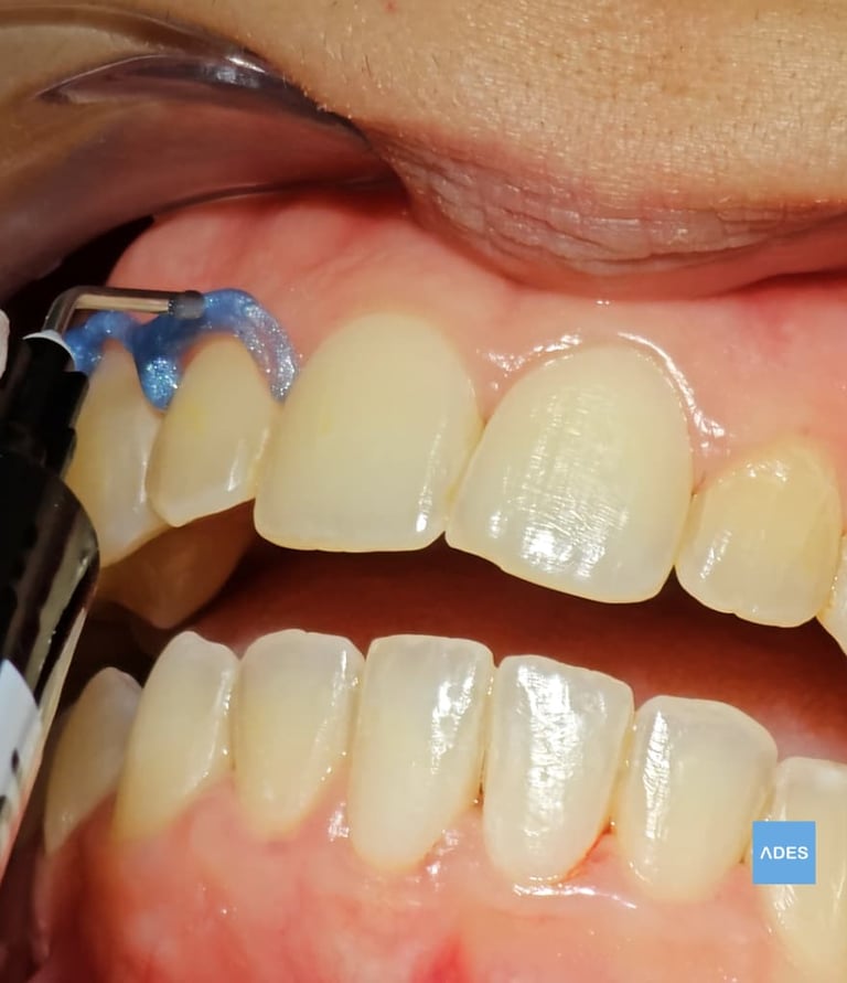 blanqueamiento dental