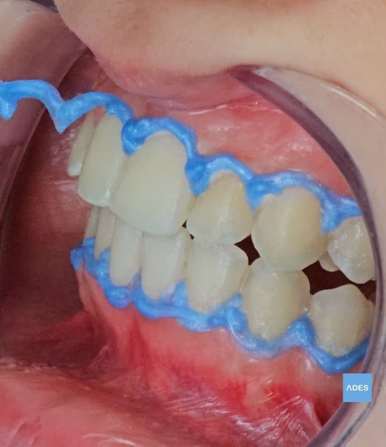 blanqueamiento dental