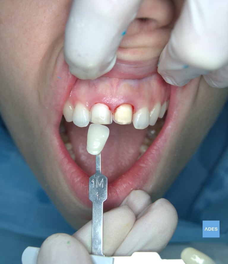 carilla dental clinica dental ades