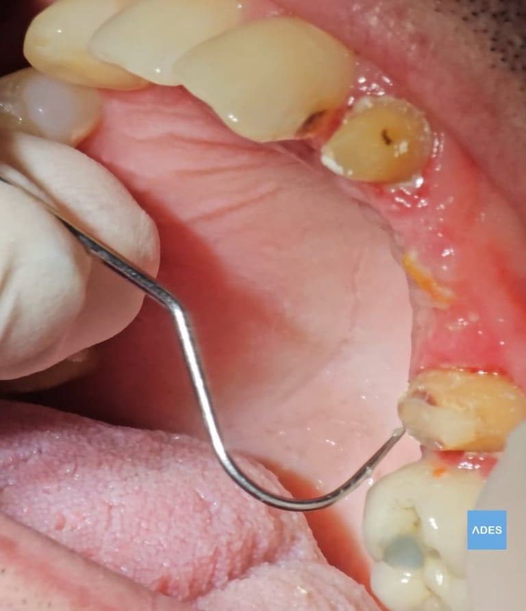 puente dental