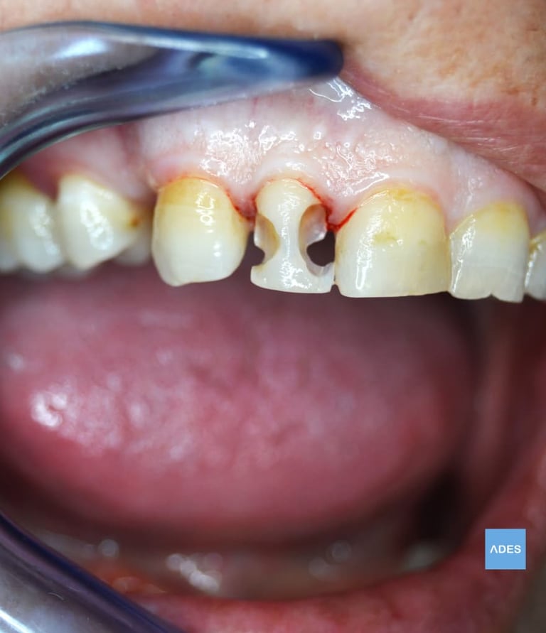 reconstruccion dental. clinica dental ades badajoz