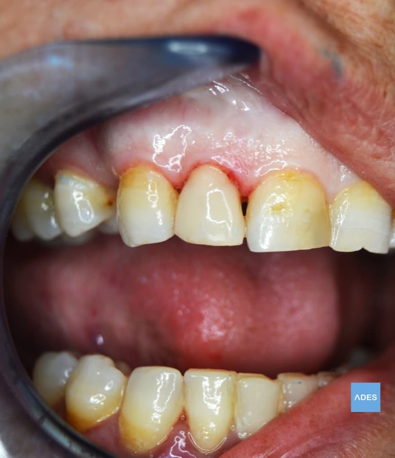reconstrucción dental 