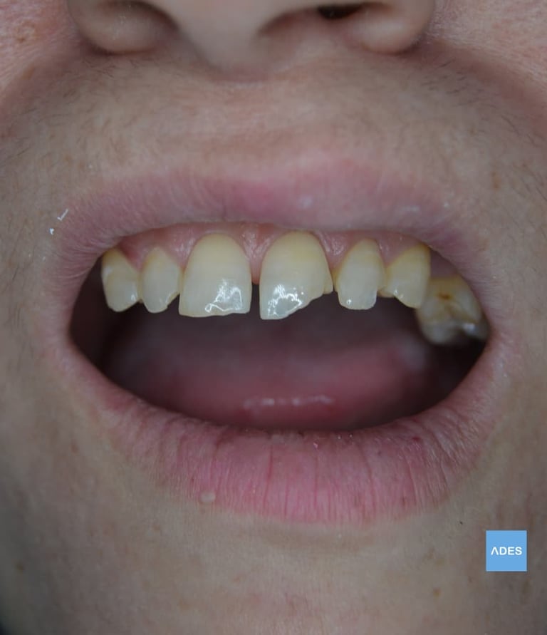 fractura dental