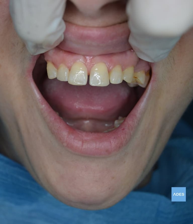 restauración dental
