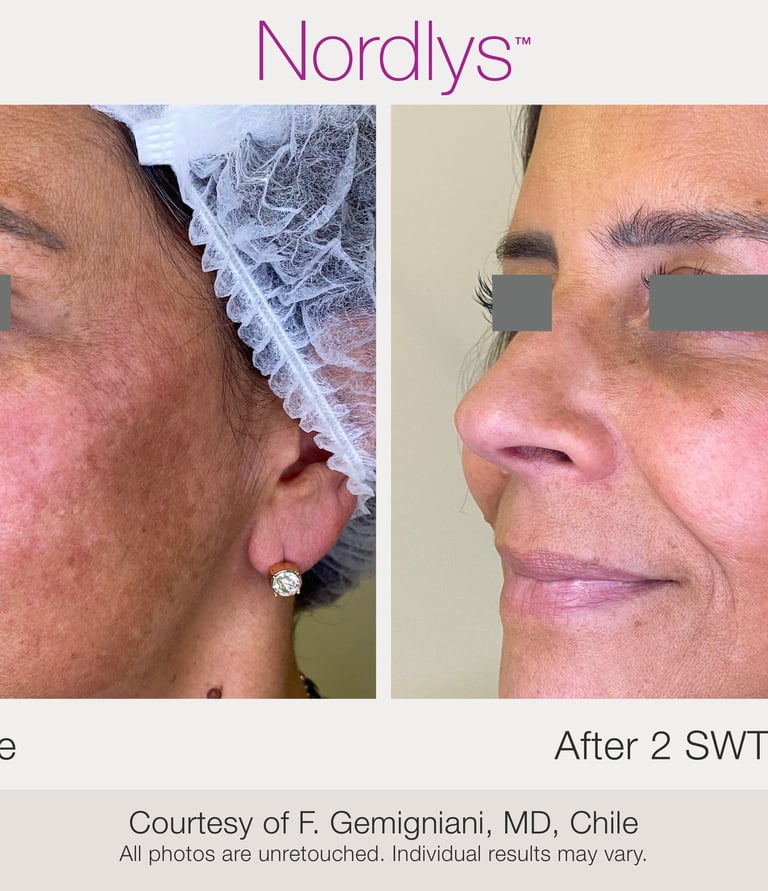 before and after acne and skin treatment results in Hamilton clinic