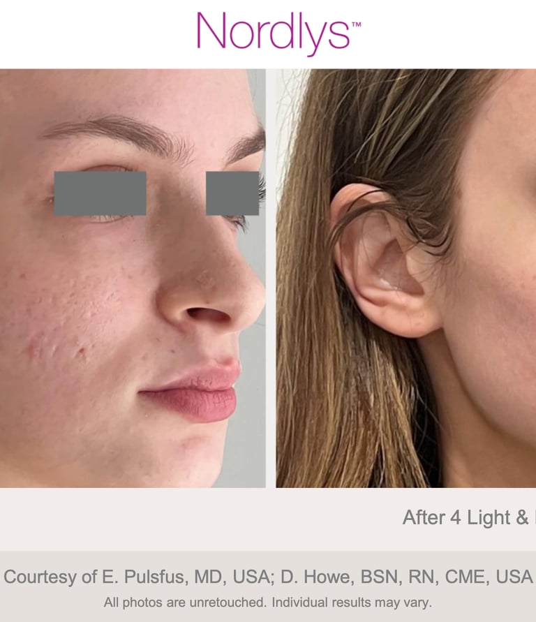 before and after pigmentation and skin improvement treatment results in Hamilton Ontario